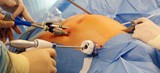 Laparoscopic surgery is a safe, effective way of removing bowel tumours and shou