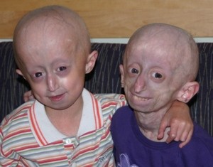 Boy and girl with progeria. Progeria Research Foundation