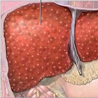 Consortium finds chronic liver cirrhosis clues
