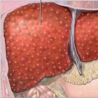 Consortium finds chronic liver cirrhosis clues