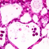 New cell death mechanism has implications for breast cancer treatments