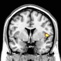 Scans reveal differences in brain structure in teenagers with conduct disorder