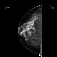 Scientists discover first breast cancer ‘oncogene&rsquo; in five years