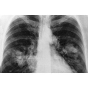 Courtesy of  Cancer Research UK