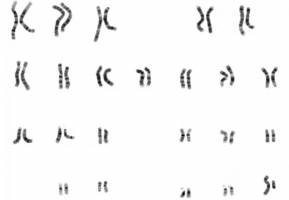 DNA flaws may contribute to cancer risk in people with type 2 diabetes