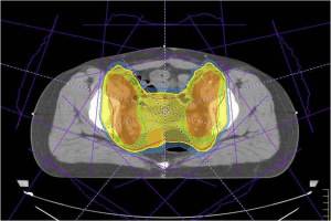 New European study will devise ways to reduce the side-effects of radiotherapy