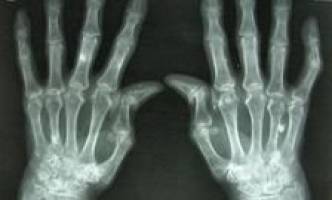New method of identifying people at a high risk of developing rheumatoid arthritis