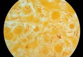 Scientists step towards improved diagnostic test for TB