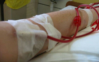 Kidney failure patients among worst affected during COVID-19