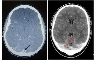 New light shed on treatment of rare cases of blood clotting in brain following Covid-19 vaccination