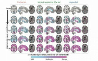 New multiple sclerosis subtypes identified using artificial intelligence