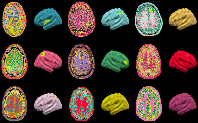 Brain abnormalities identified by the MELD AI algorithm (highlighted in lime gre