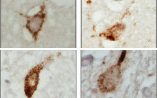 Discovery of new ALS and dementia disease mechanism raises treatment hopes