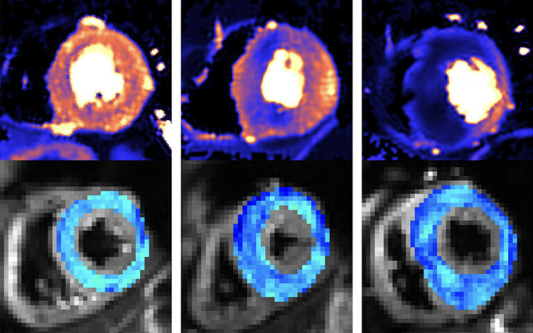 MRI images of the hearts of a healthy volunteer (left), individual with HCM gene