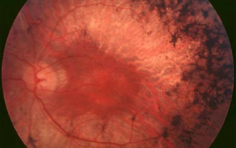 Eye with retinitis pigmentosa - Fundus (back of the eye) of patient with retinit