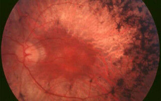 Blindness from some inherited eye diseases may be caused by gut bacteria