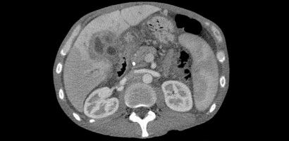 New study aims to catch cancer earlier than ever before