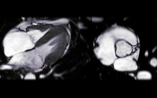 Why more men than women are diagnosed with deadly heart disease