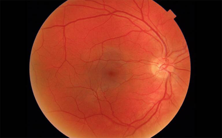 Retinal scan - Retinal scan. Credit: Moorfields Eye Hospital