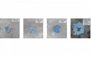 AI model to improve clinical trial recruitment for eye disease