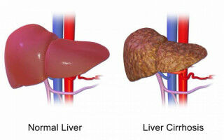 Albumin provides no benefit to hospitalised patients with advanced liver disease