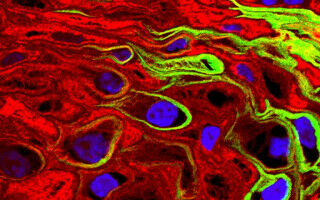 Cervical cancer survival increases with better use of existing drugs