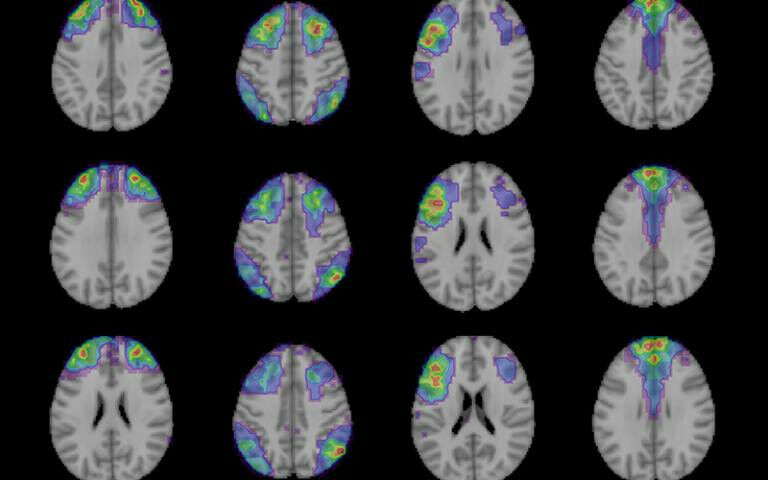 Brain scans - Brain areas involved in decision acuity identified in a study invo