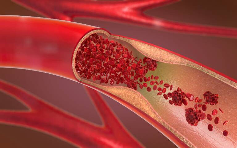 3d illustration of a constricted and narrowed artery and the blood cannot flow p