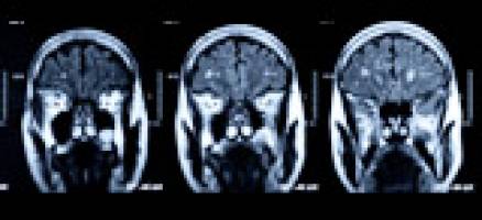 Scientists secure �244k boost for dementia research