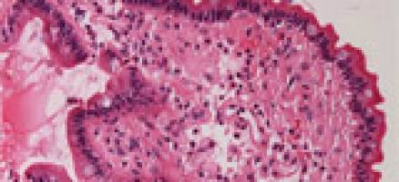 Unfolding amyloid secrets